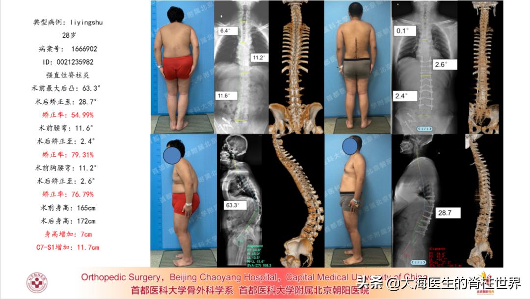 周杰伦强直性脊柱炎_艺人中有谁是克罗恩病_张嘉译强直性脊柱炎症状