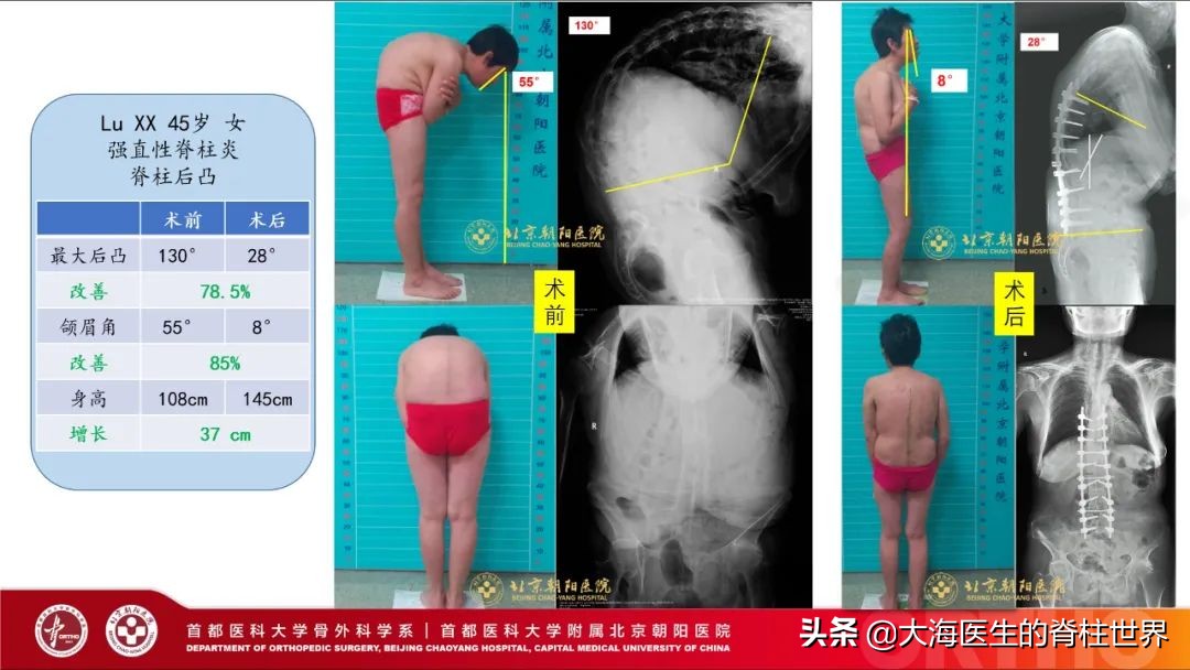 张嘉译强直性脊柱炎症状_周杰伦强直性脊柱炎_艺人中有谁是克罗恩病