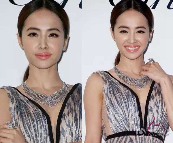 微整形 玻尿酸注射风险 _微整失败不吸收图片_ 玻尿酸交联后遗症