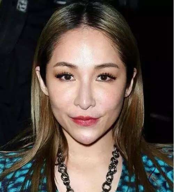 微整失败不吸收图片_微整形 玻尿酸注射风险 _ 玻尿酸交联后遗症